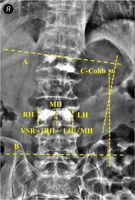 Frontiers Multilevel Unilateral Versus Bilateral Pedicular